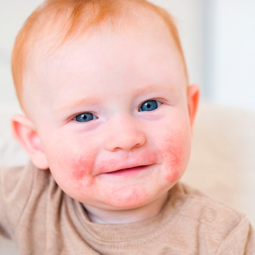 Capa Alimentação Infantil Dermatite Atópica